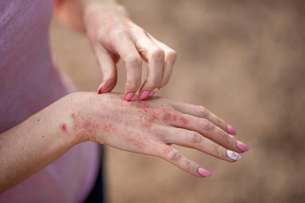 dermatitis por contacto alergia